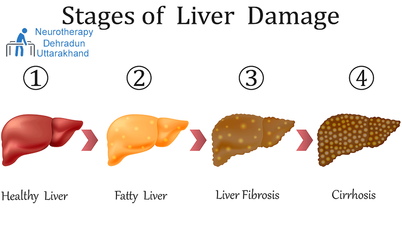 Fatty Liver