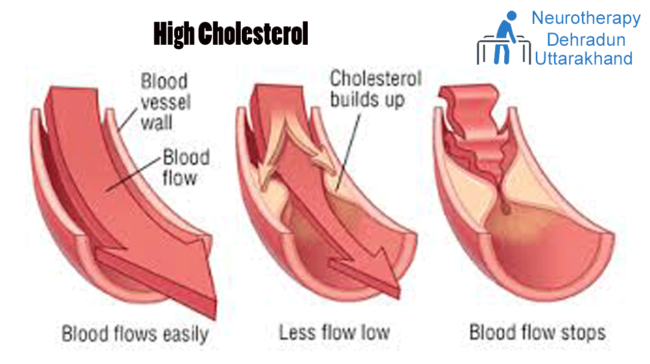 High Cholesterol