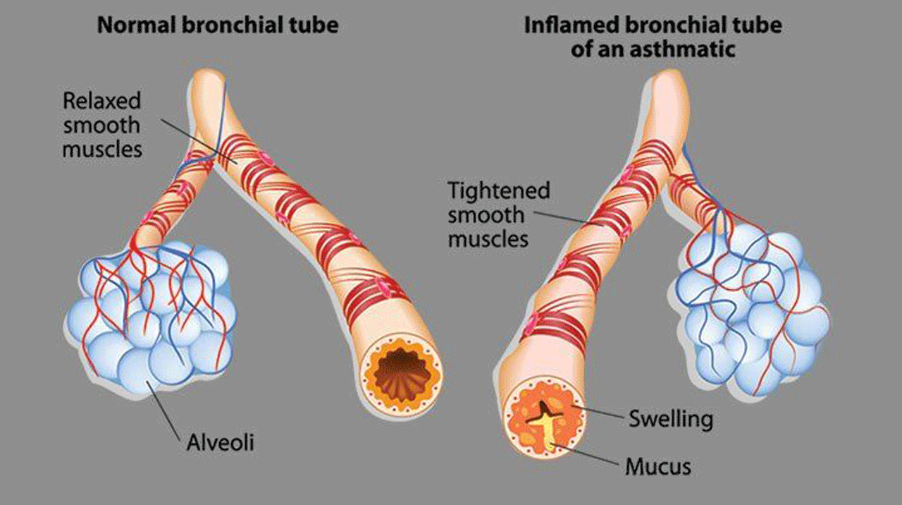 Asthama