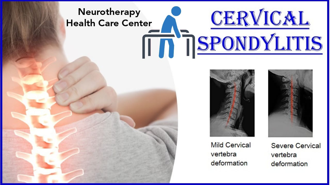 Cervical Spondylitis